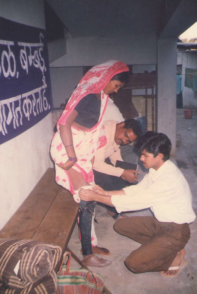 Jaipur foot being fitted at the Jaipur foot Centre